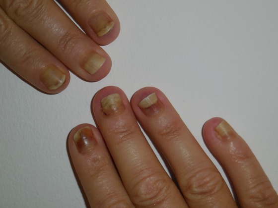 Onycholysis
