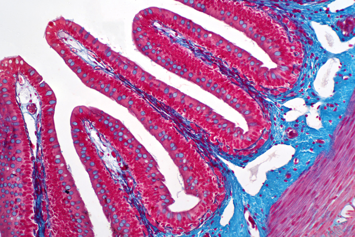 colon cancer