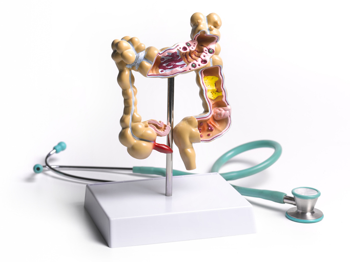 colon cancer